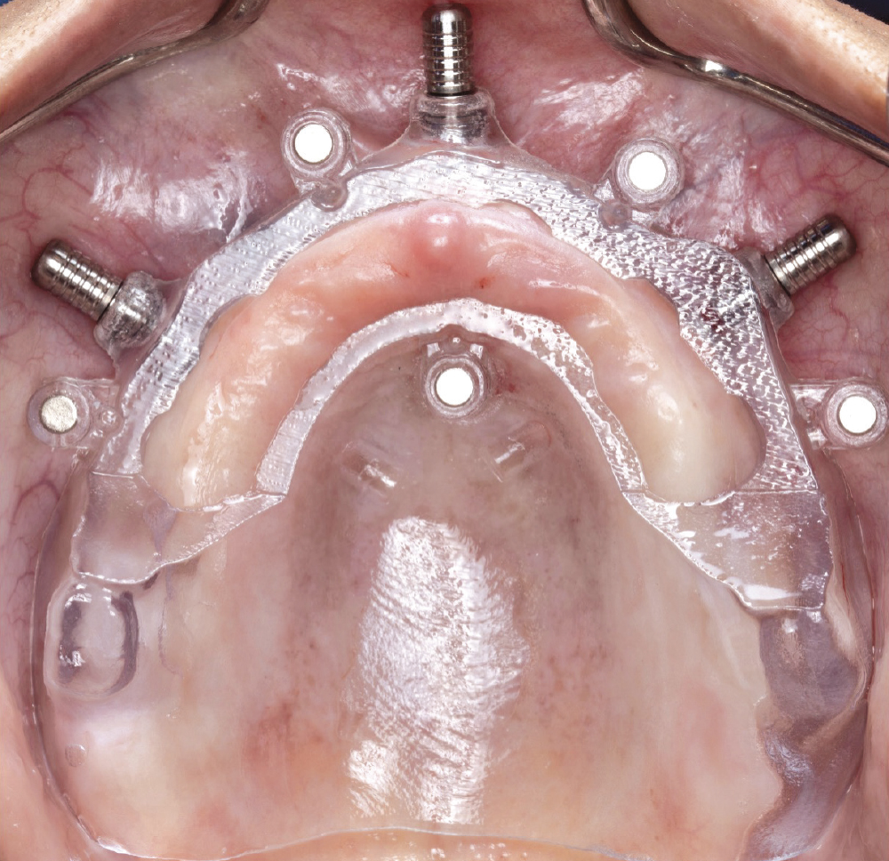 Tissue-supported guides are held in place by mucosa and fixation pains. No reflection of soft tissue is necessary when using these types of guides.
