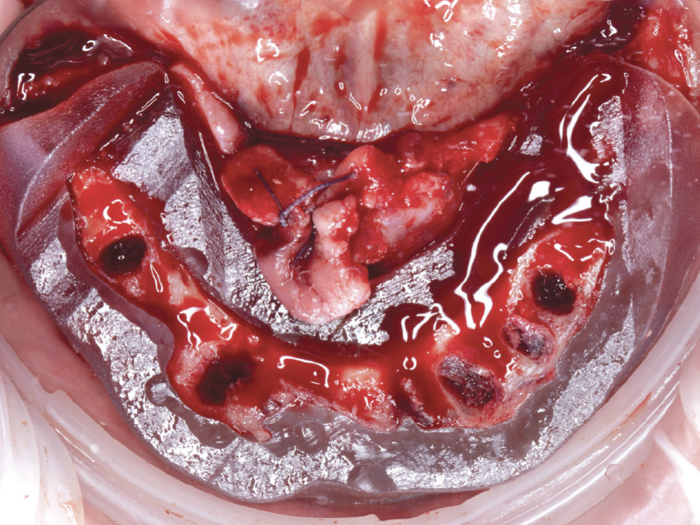 After flapping the soft tissue, bone-supported surgical guides are anchored to the alveolar ridge and/or load-bearing bony anatomy for support. Bone-supported guides fabricated by the Glidewell DTP team now also come with a bone-reduction guide to ensure accurate bone levelling.