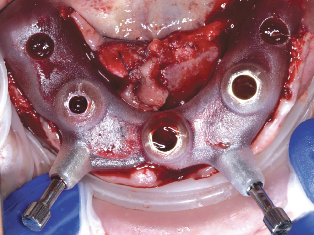 After flapping the soft tissue, bone-supported surgical guides are anchored to the alveolar ridge and/or load-bearing bony anatomy for support. Bone-supported guides fabricated by the Glidewell DTP team now also come with a bone-reduction guide to ensure accurate bone levelling.