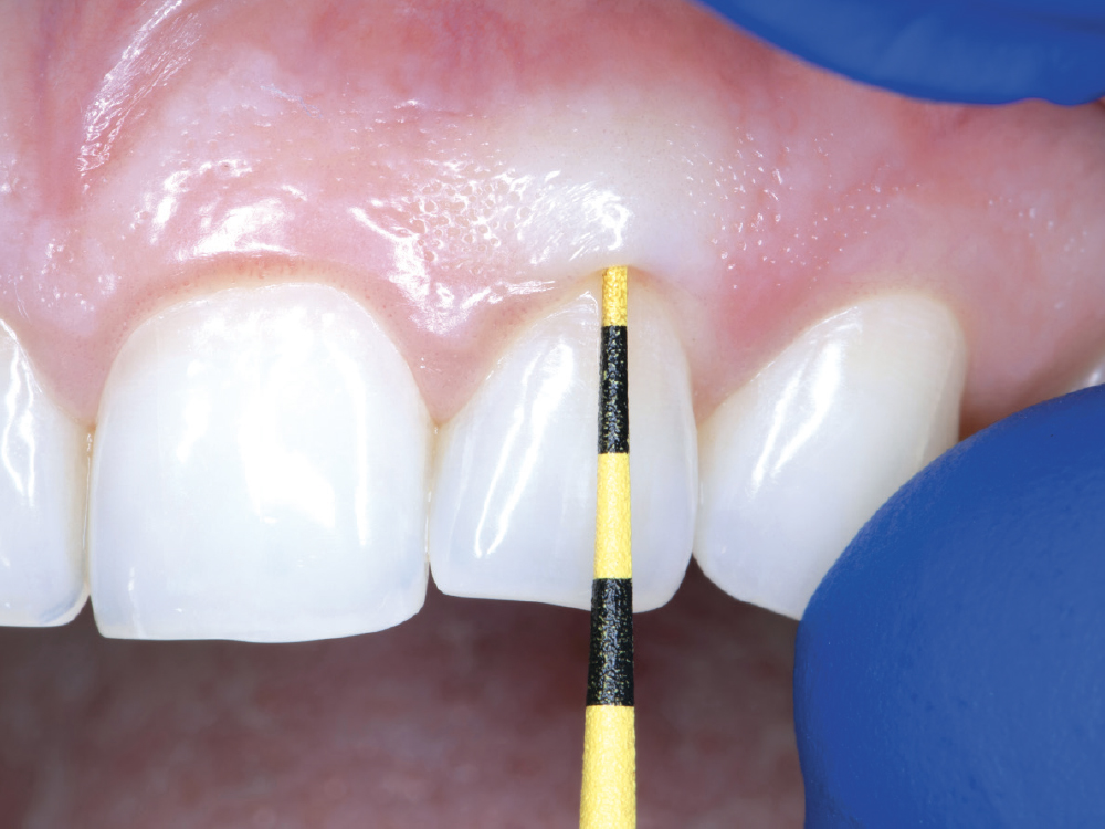 In the esthetic zone, assessing the gingival biotype helps identify the challenges associated with managing soft tissue.