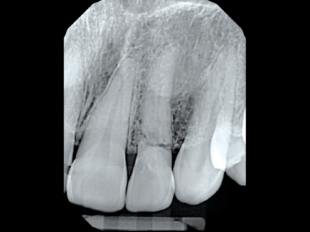 The radiograph shows what we cannot see clinically.