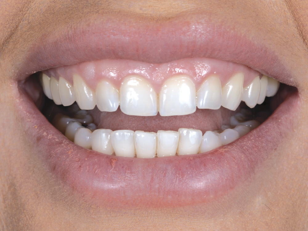 This case was esthetically challenging due to the patient’s high smile line. Discussing the risks and managing expectations with the patient is important during the treatment planning phase.