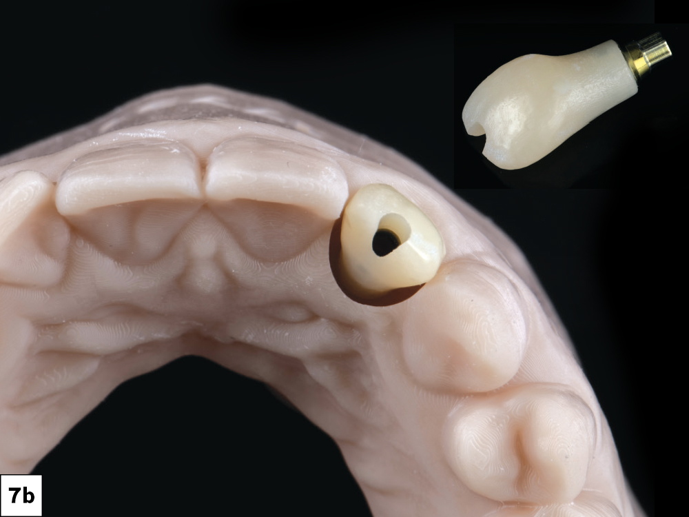 screw-retained restoration was chosen to eliminate the risk of cement contamination on the day of surgery. Providing an immediate provisional achieves several objectives