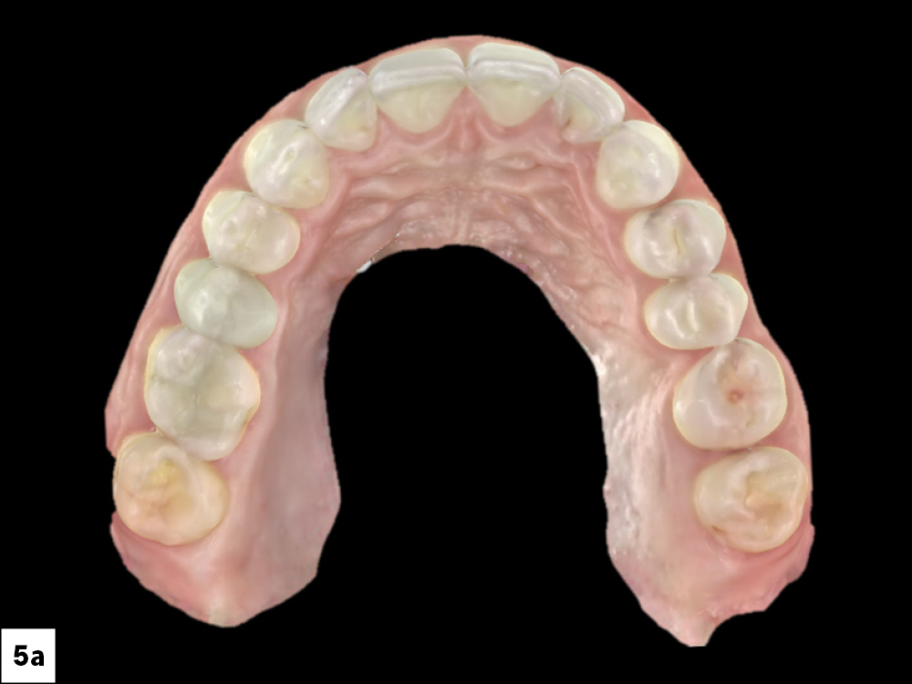 An intraoral scan of the patient’s mouth was taken using the fastscan.io™ Scanning Solution. This scan aids in visualizing the treatment plan and facilitates co-diagnosis with the patient. This same scan can then be used for implant planning and fabricating a surgical guide.
