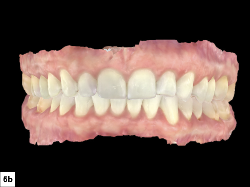 An intraoral scan of the patient’s mouth was taken using the fastscan.io™ Scanning Solution. This scan aids in visualizing the treatment plan and facilitates co-diagnosis with the patient. This same scan can then be used for implant planning and fabricating a surgical guide.