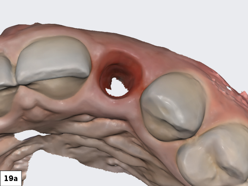 The scan body was then registered with the IOS. With the soft tissue previously scanned and locked in place, there was no concern about the soft tissue collapsing while the scan body was being radiographed and its position captured.