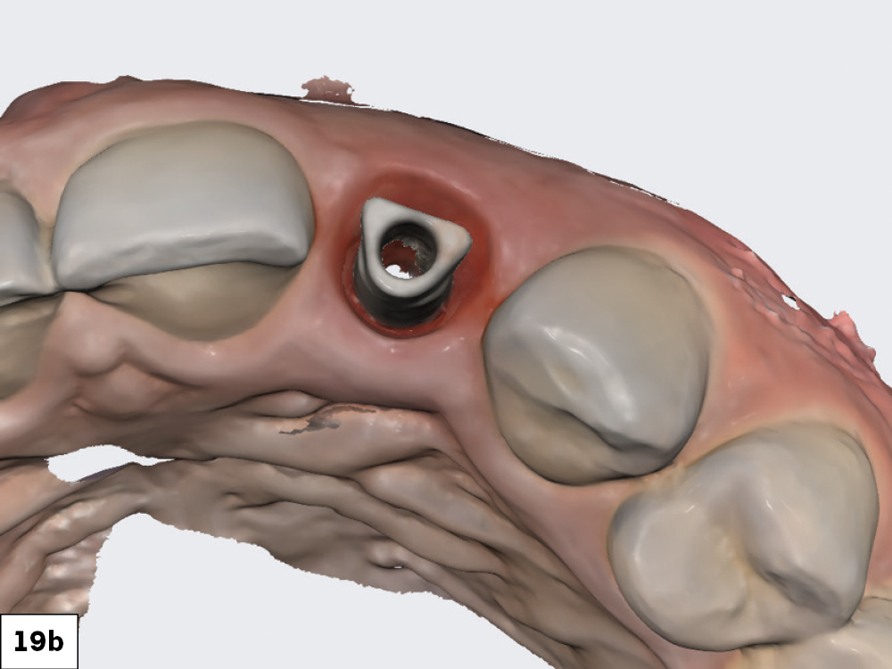 The scan body was then registered with the IOS. With the soft tissue previously scanned and locked in place, there was no concern about the soft tissue collapsing while the scan body was being radiographed and its position captured.