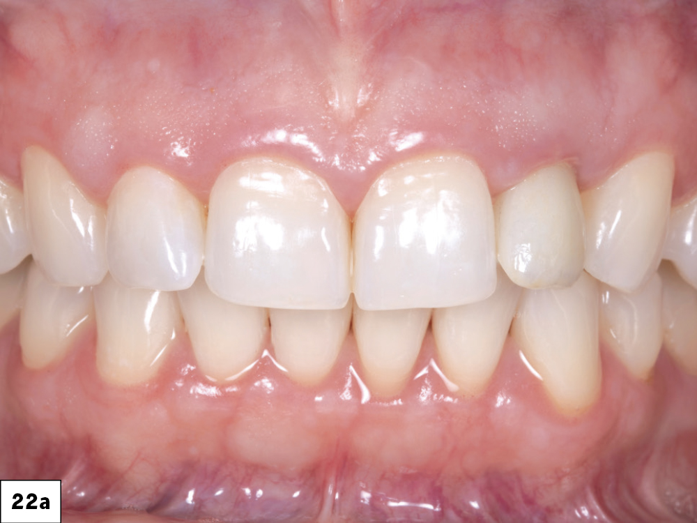 The Glidewell HT implant, custom hybrid abutment, and BruxZir Esthetic cement-retained restoration were successfully delivered without compromising the hard-or soft-tissue contours.