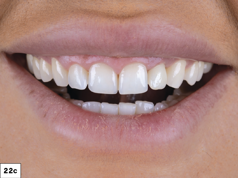 To protect against further damage to the teeth and the newly placed implant, an occlusal guard was prescribed.