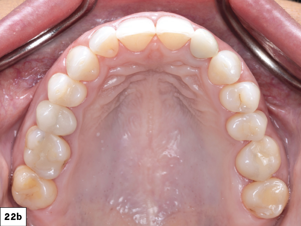 The Glidewell HT implant, custom hybrid abutment, and BruxZir Esthetic cement-retained restoration were successfully delivered without compromising the hard-or soft-tissue contours.