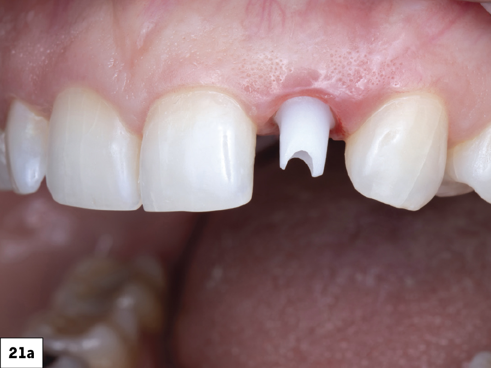 The abutment was tried in to verify the marginal position and then hand-tightened into place. An X-ray was then taken to ensure the abutment was fully seated. Because a 3.0 mm Glidewell HT implant was placed, the abutment was torqued to 15 Ncm.