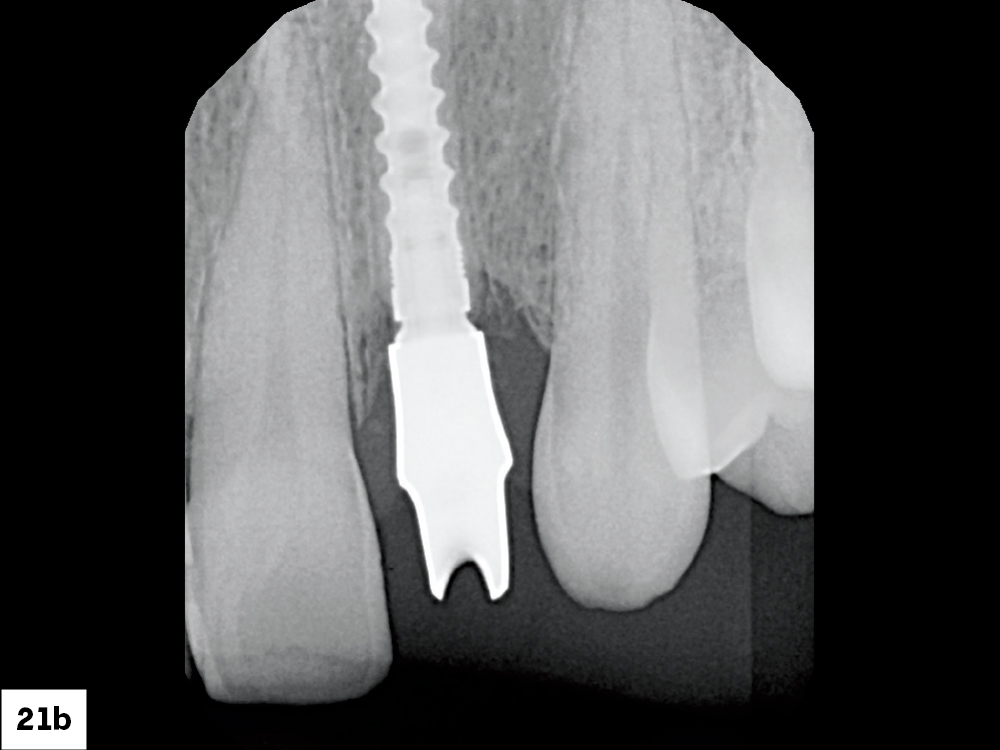The abutment was tried in to verify the marginal position and then hand-tightened into place. An X-ray was then taken to ensure the abutment was fully seated. Because a 3.0 mm Glidewell HT implant was placed, the abutment was torqued to 15 Ncm.