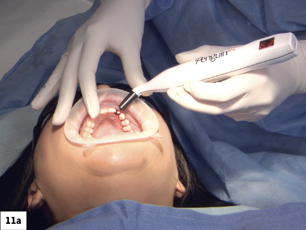 An Implant Stability Quotient (ISQ) can help assess whether the implant is suitable for immediate loading. The Glidewell HT™ Implant System (Glidewell Direct; Irvine, Calif.), formerly known as the Hahn™ Tapered Implant System