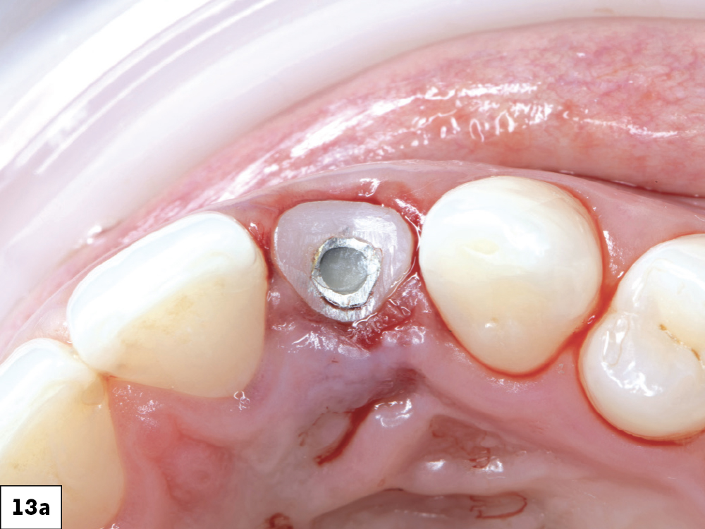 The emergence profile created by the custom healing abutment is crucial for maintaining the gingival architecture, ensuring proper alignment of the papilla, margins, and soft tissue. The healing abutment helps retain the patient’s natural tooth appearance as closely as possible throughout the healing process.