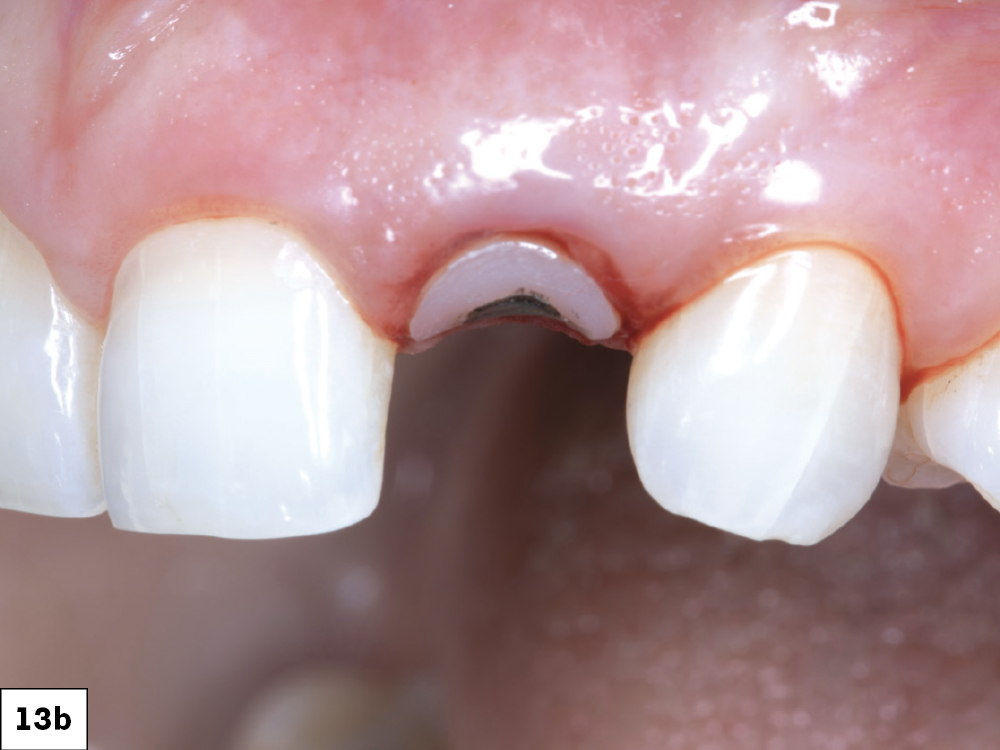 The emergence profile created by the custom healing abutment is crucial for maintaining the gingival architecture, ensuring proper alignment of the papilla, margins, and soft tissue. The healing abutment helps retain the patient’s natural tooth appearance as closely as possible throughout the healing process.