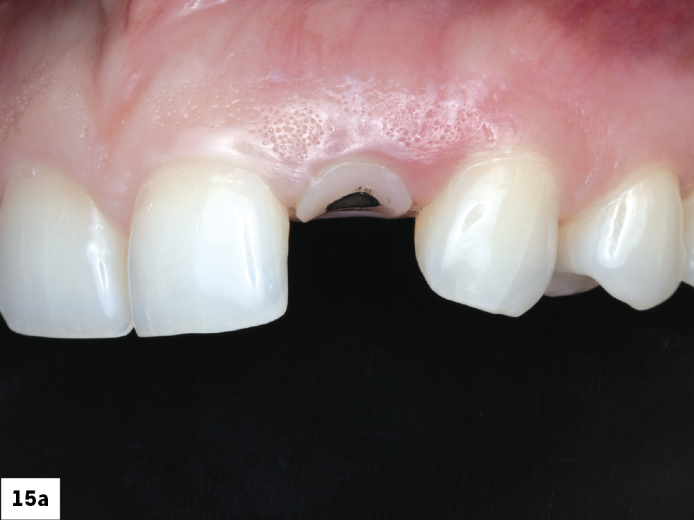 The patient returned three months later for an evaluation. The gingival architecture was observed to be well-maintained and healed effectively. A shade map of the tooth was created and documented.