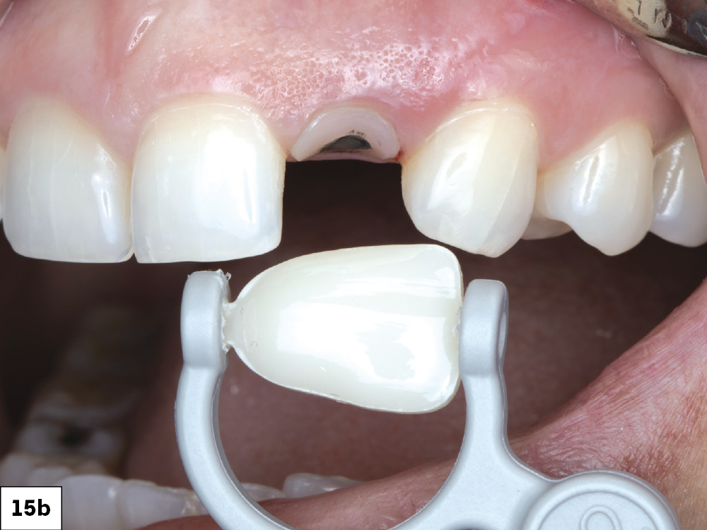 The patient returned three months later for an evaluation. The gingival architecture was observed to be well-maintained and healed effectively. A shade map of the tooth was created and documented.