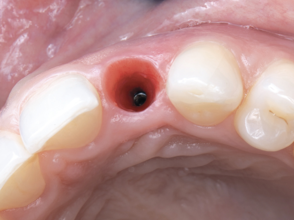 Before removing the healing abutment, intraoral scans of the maxillary and mandibular arches were acquired.