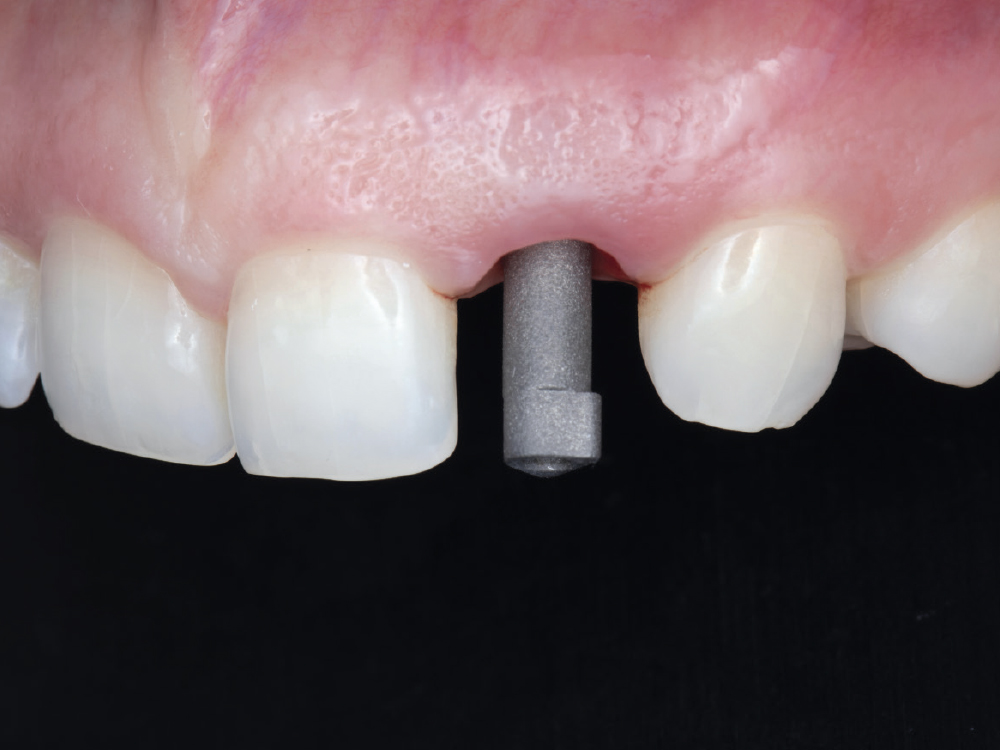 Once the soft tissue was scanned, the scan body was seated and hand tightened.