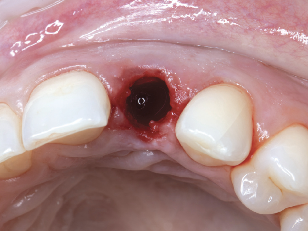 The tooth was removed as atraumatically as possible. Due to its ankylosed condition, portions of the root needed to be removed with a surgical carbide bur.