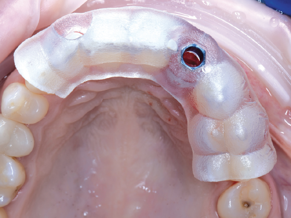 After extracting the tooth, the surgical guide was tried in. Once it was confirmed that the guide was fully seated, the osteotomy was performed.