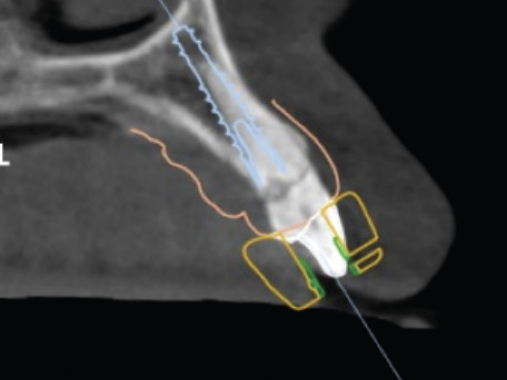A CBCT scan was taken to evaluate the quantity and quality of the surrounding bone.