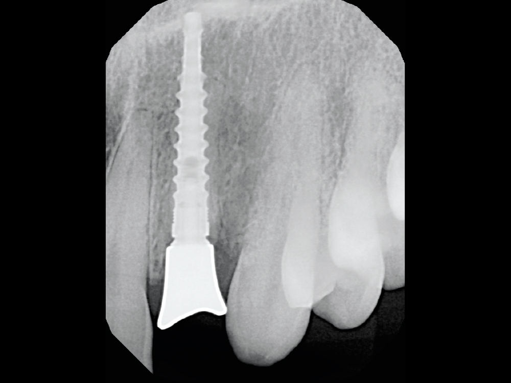This radiograph shows the Glidewell HT 3.0 implant with the seated custom healing abutment.