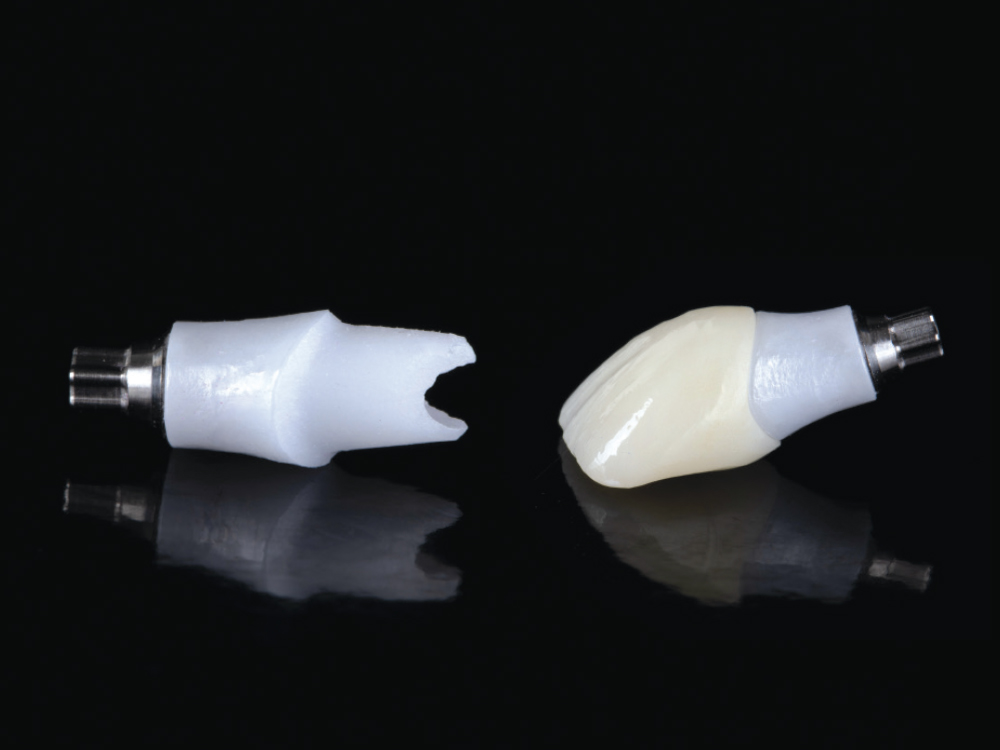 As determined from the digital treatment plan prior to extraction and implant placement, a custom hybrid abutment and a cement-retained BruxZir® Esthetic crown were fabricated.