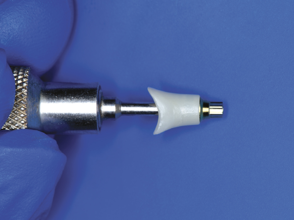 Despite the absence of parafunctional habits and the anterior location, primary stability was not optimal. Therefore, instead of delivering the provisional restoration as initially planned, it was converted into a custom healing abutment. This approach aimed to sculpt and support the soft tissue through the contours of the provisional’s emergence profile.