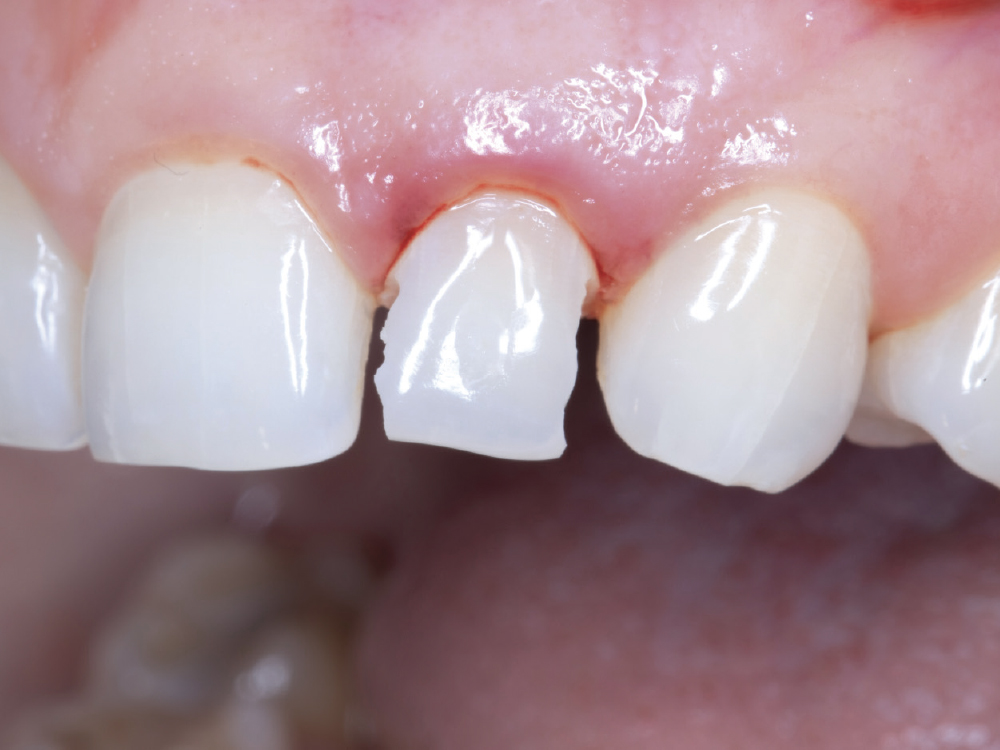 A bur was used to remove proximal tooth structure, creating space to comfortably utilize periotomes without damaging the adjacent teeth.