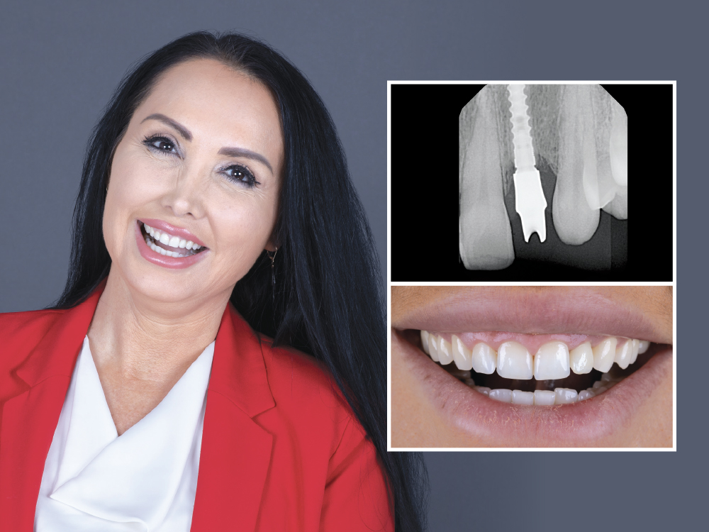 Immediate Implant Placement in the Anterior: A Case Study