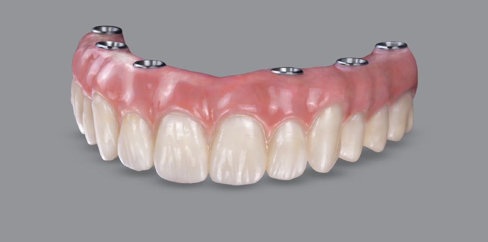 IMPLANT RESTORATIVE CONSIDERATIONS