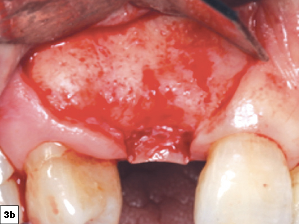 Incision design in keratinized tissue and broad-based flap design.