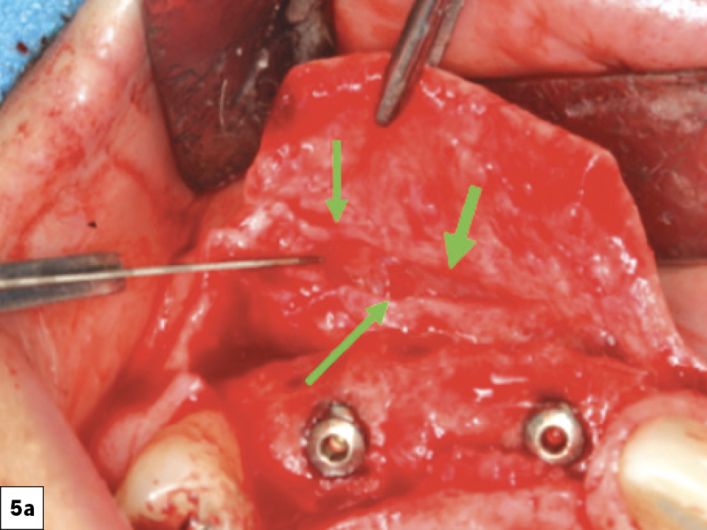 Reducing Flap Tension: (a) Periosteal incisions, (b) Blunt dissection with rounded-tipped tissue scissors.