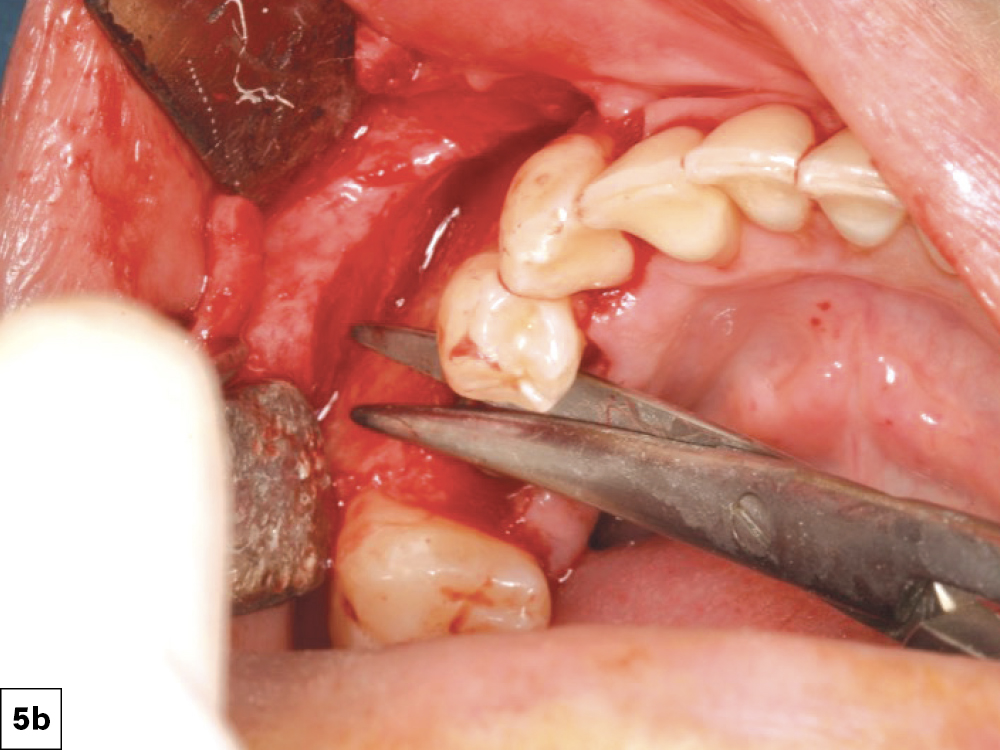 Reducing Flap Tension: (a) Periosteal incisions, (b) Blunt dissection with rounded-tipped tissue scissors.