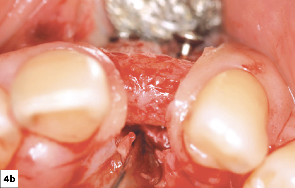 Papilla-sparing incision leaving about 1 mm of papillary tissue adjacent to the natural tooth.