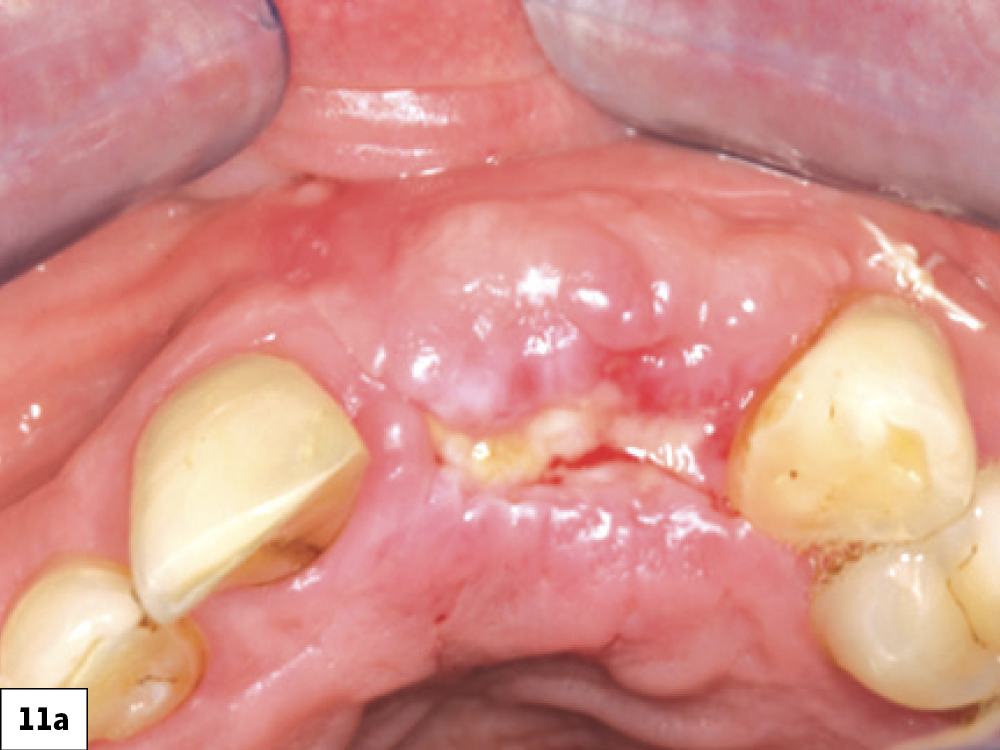 Successful healing by secondary intention: (a) two-week postop with ILO, (b) three-week post-op, (c) successful re-epithelization at four-week post-op.