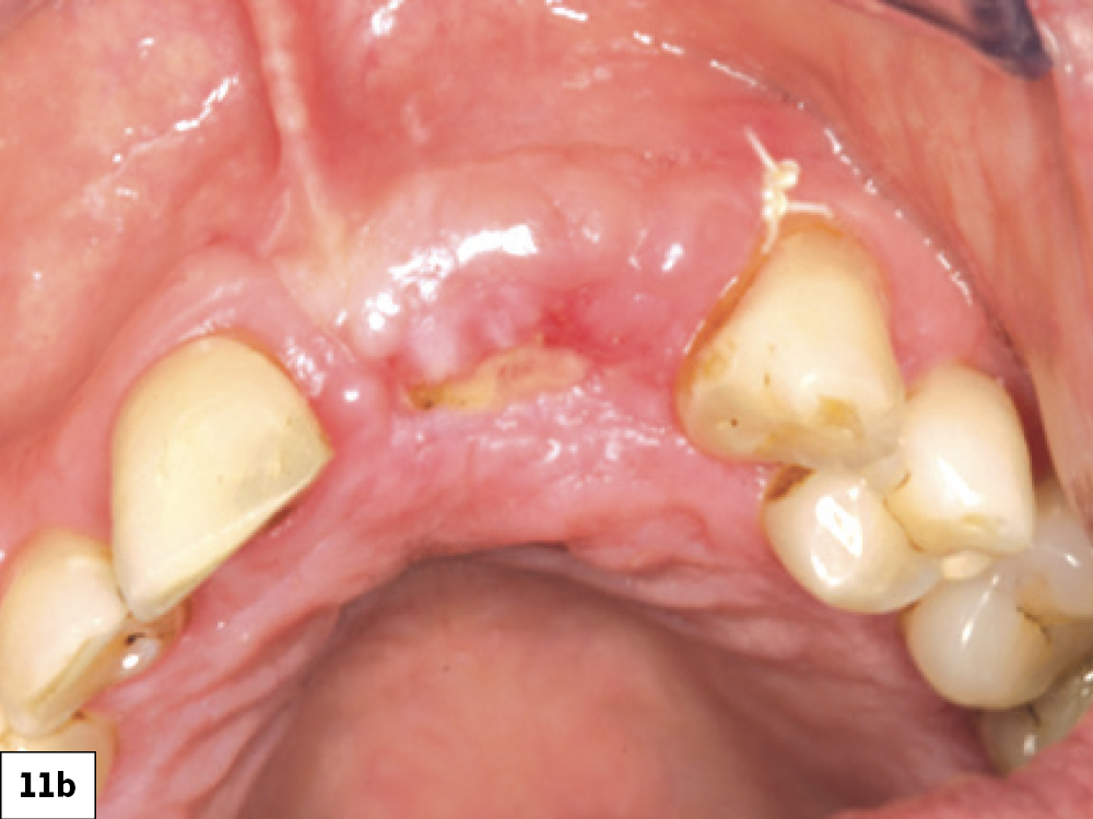 Successful healing by secondary intention: (a) two-week postop with ILO, (b) three-week post-op, (c) successful re-epithelization at four-week post-op.