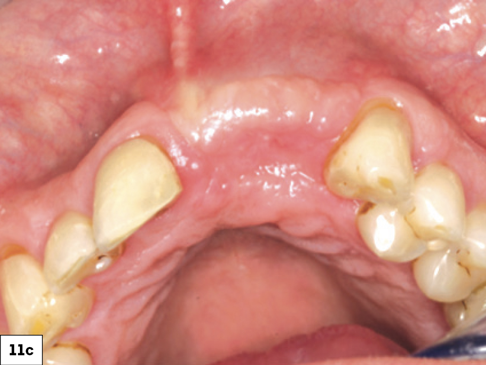Successful healing by secondary intention: (a) two-week postop with ILO, (b) three-week post-op, (c) successful re-epithelization at four-week post-op.