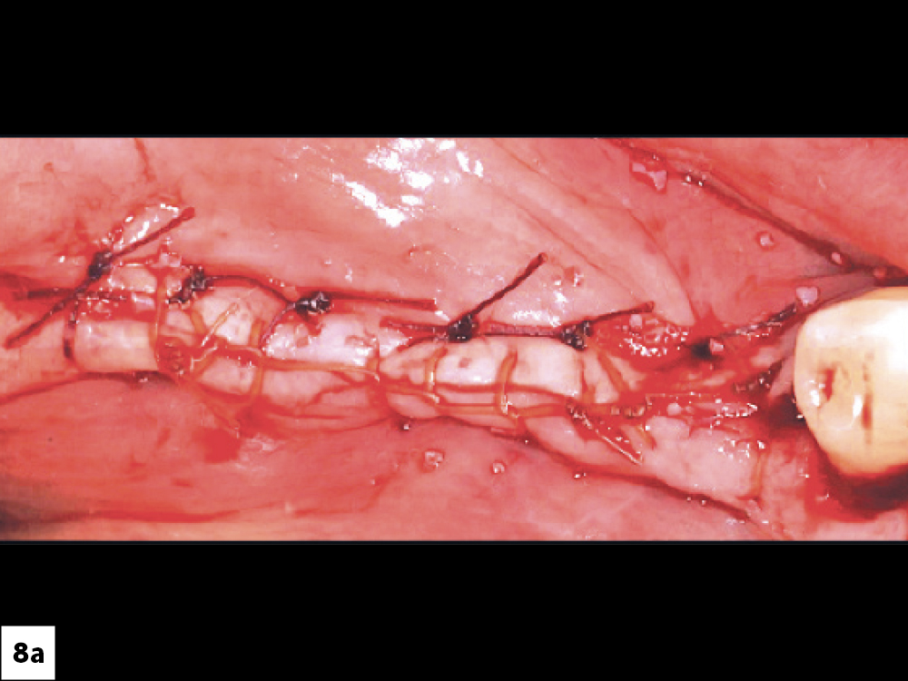 Ideal Suturing Technique: (a) Continuous locking suture with supplemental horizontal sutures, (b) results in “eversion” of the tissue, thereby preventing muscle pull ILO.