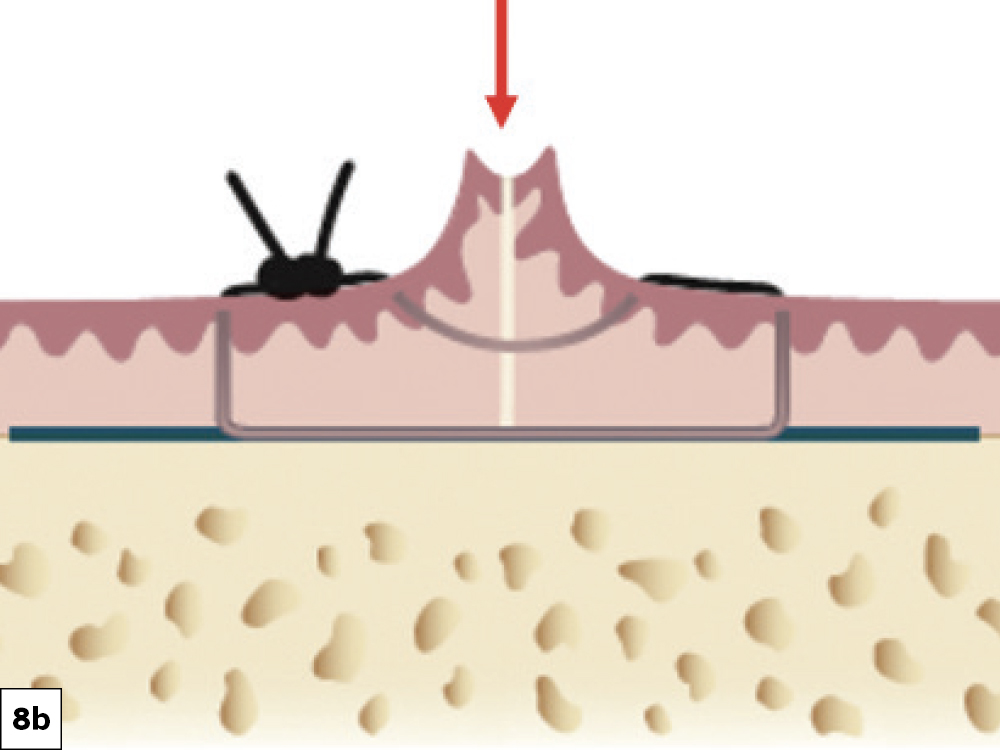 Ideal Suturing Technique: (a) Continuous locking suture with supplemental horizontal sutures, (b) results in “eversion” of the tissue, thereby preventing muscle pull ILO.