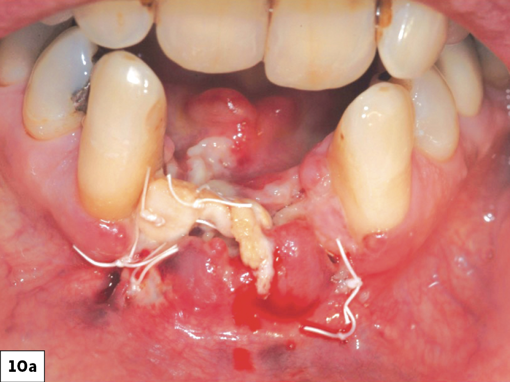 Resuturing ILO: (a) Oneweek post-op following bone graft, (b) Twoweek post-op after unsuccessful re-suturing of the surgical wound.