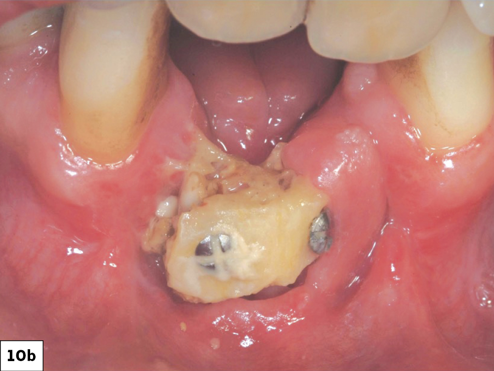 Resuturing ILO: (a) Oneweek post-op following bone graft, (b) Twoweek post-op after unsuccessful re-suturing of the surgical wound.