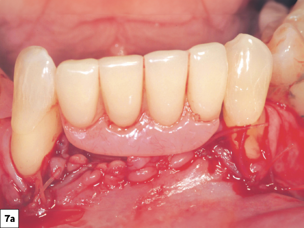Interim Prosthesis Pressure: (a) The prosthesis should be evaluated for direct pressure on the surgical site, (b) removal of any areas of tissue impingement.