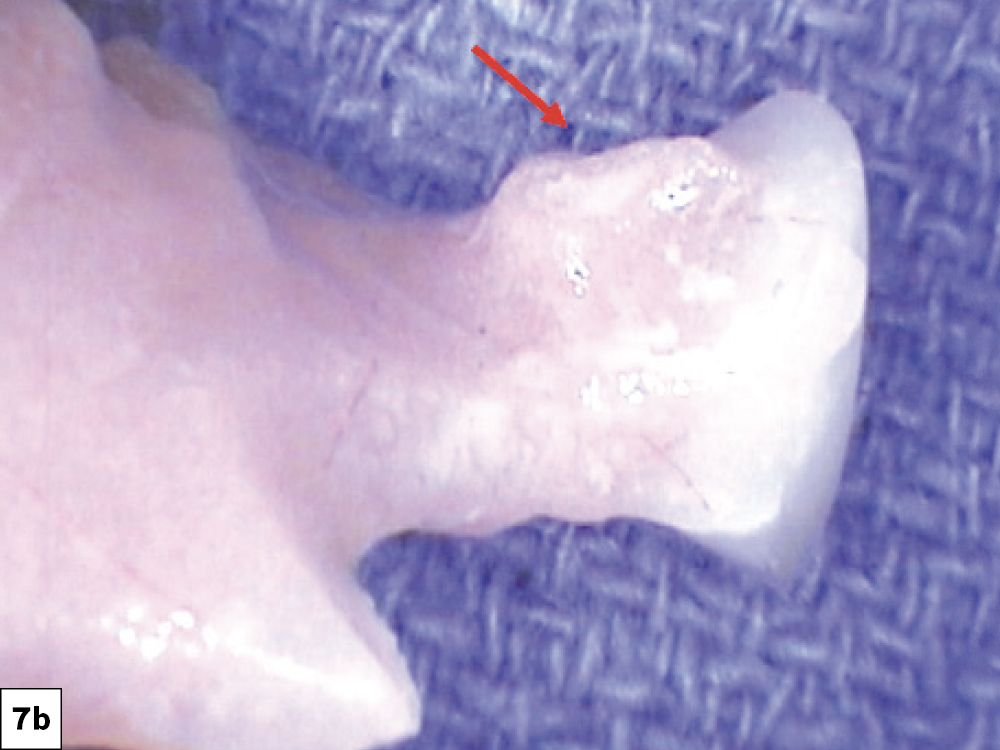 Interim Prosthesis Pressure: (a) The prosthesis should be evaluated for direct pressure on the surgical site, (b) removal of any areas of tissue impingement.