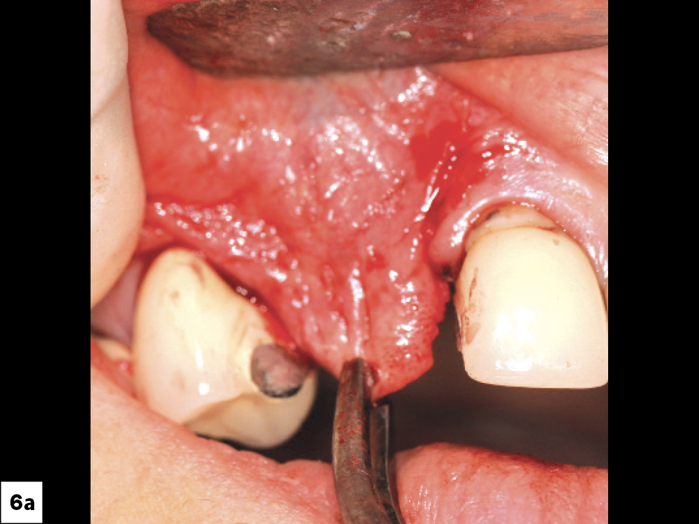 Tension Free Tissue: (a) Reduction of tissue tension, (b) Ideally tissue should be able to be re-approximated more than 5 mm across the suture line.