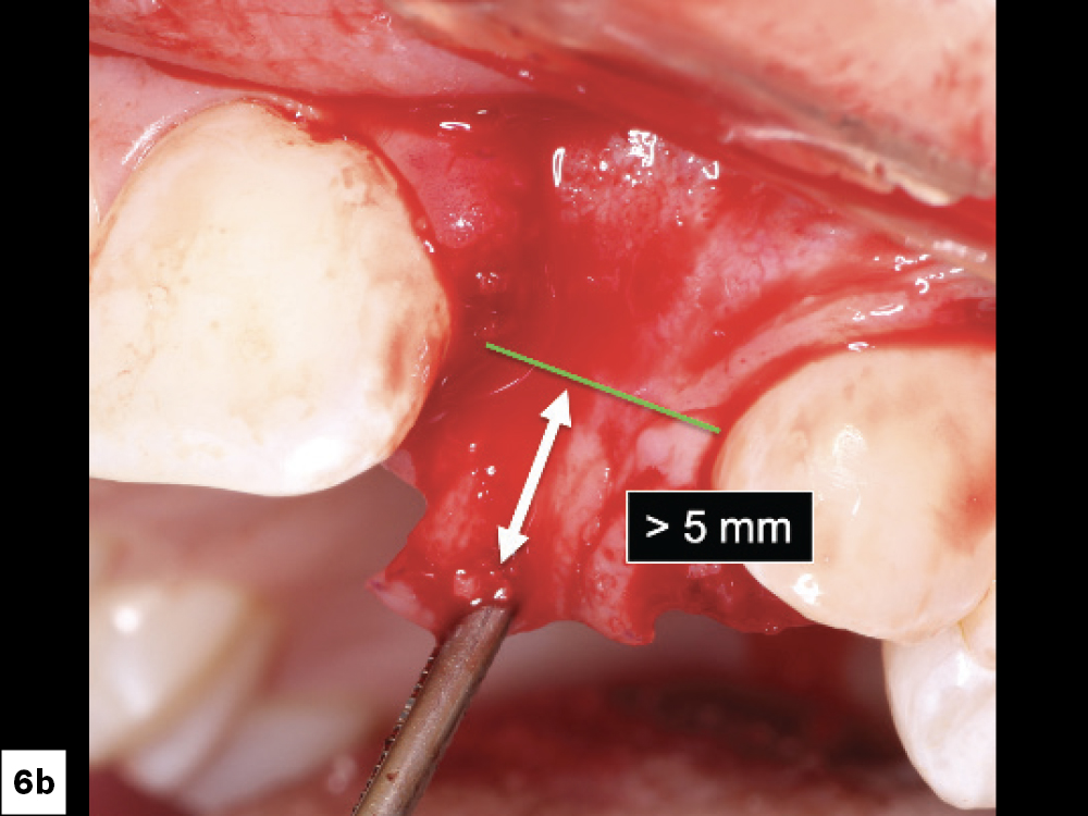 Interim Prosthesis Pressure: (a) The prosthesis should be evaluated for direct pressure on the surgical site, (b) removal of any areas of tissue impingement.