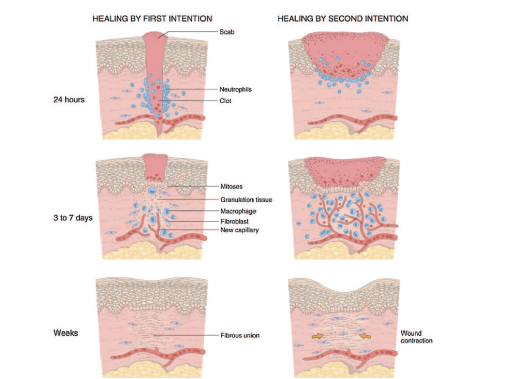 Primary and secondary intention wound healing.