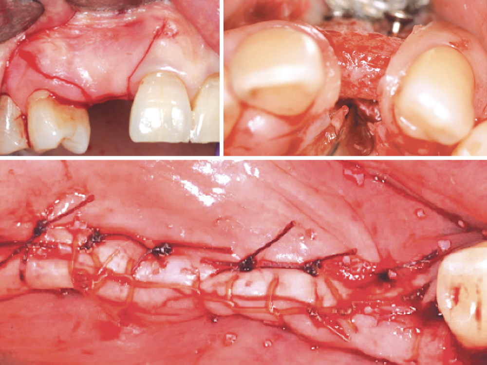 Management of Incision Line Opening