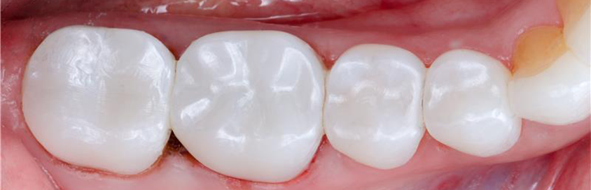 After-Bruxzir-NOW-Posterior